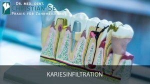 Karies behandeln ohne Bohren | Zahnarzt in Aachen Dr. med. dent. Christian Selle | Social